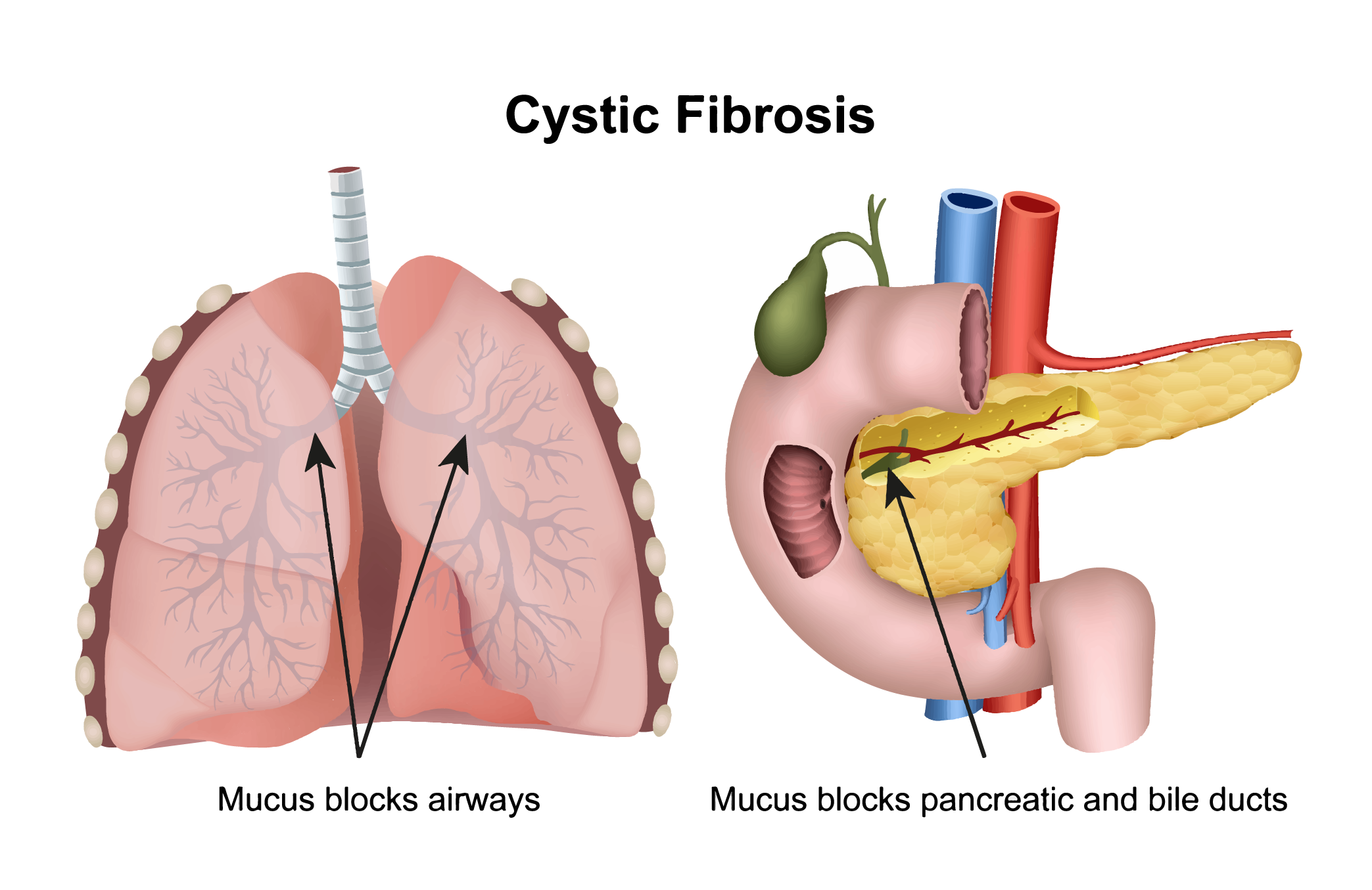 pediatric-cystic-fibrosis-ohsu